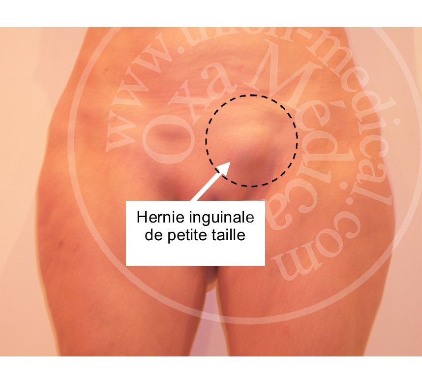 Photo d'une hernie inguinale de petite taille